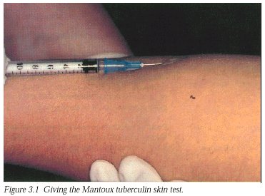 positive mantoux skin test