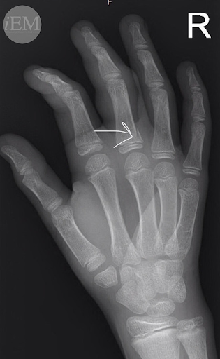 Hand/Wrist X-ray