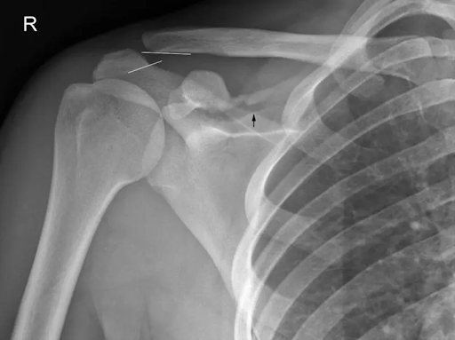 Right Shoulder X-ray